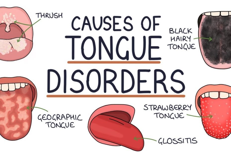 Understanding Tongue Disorders: Causes and Management