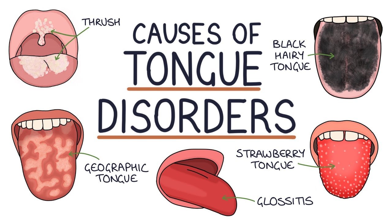 Understanding Tongue Disorders: Causes and Management Understanding Tongue Disorders: Causes and Management