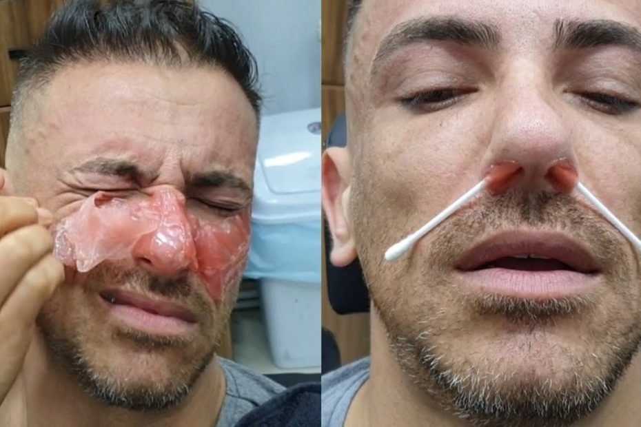 Amazing Waxing Eyebrow Full Face Waxing For Men - Youtube