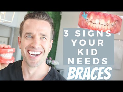 When do YOU need braces? | What Age is Best for Braces